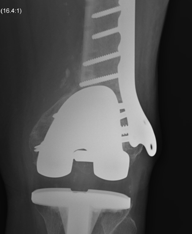 Periprosthetic Locking Plate Nonunion